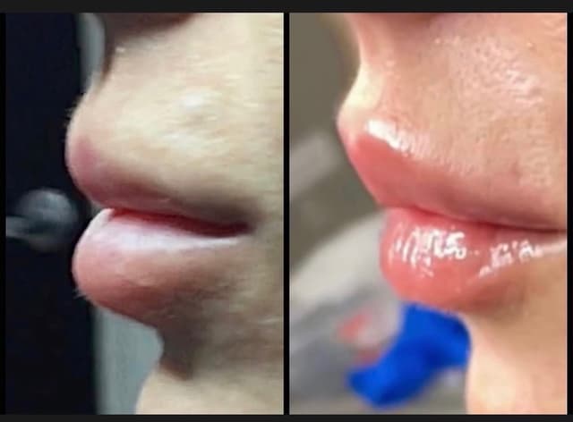 Lip filler injection before and after