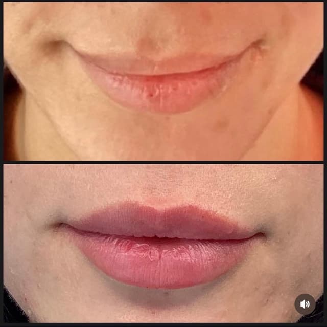 Lip filler injection before and after