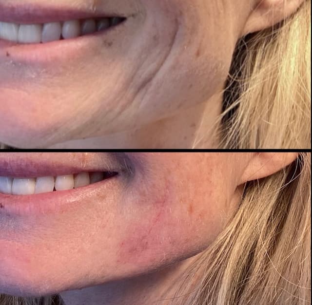 Jawline Filler before and after