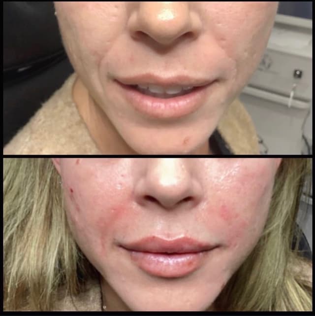Lip filler injection before and after