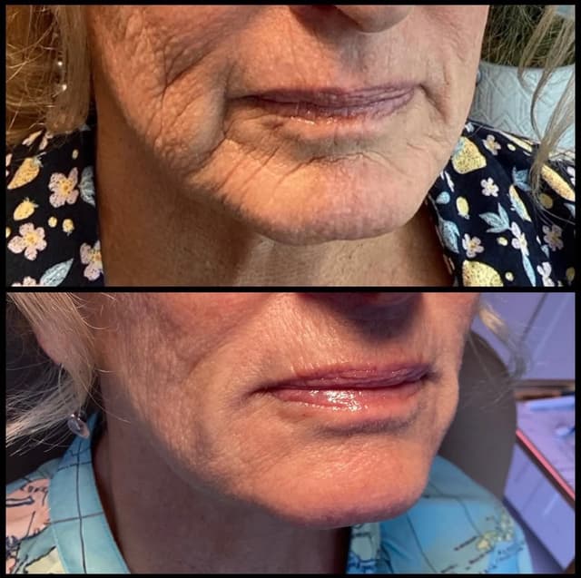 Jawline and chin filler before and after